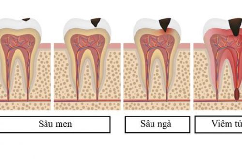 Toàn cảnh về bệnh sâu răng và biện pháp đề phòng