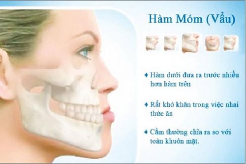 Làm sao để hết 'móm'?