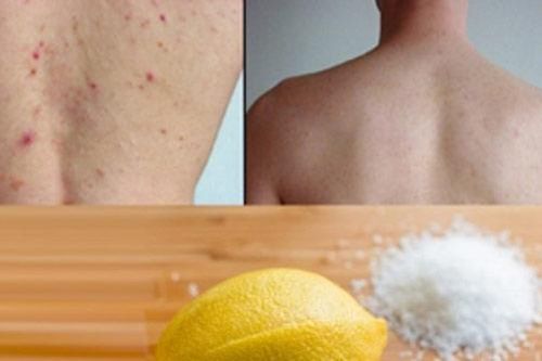 3 cách trị mụn lưng cấp tốc, hiệu quả cao tại nhà mà bạn gái nào cũng nên biết