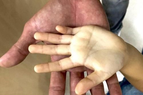 Bé gái 3 tuổi thiếu máu nặng do uống 10 hộp sữa tươi mỗi ngày, bác sĩ cảnh báo sai lầm của phụ huynh