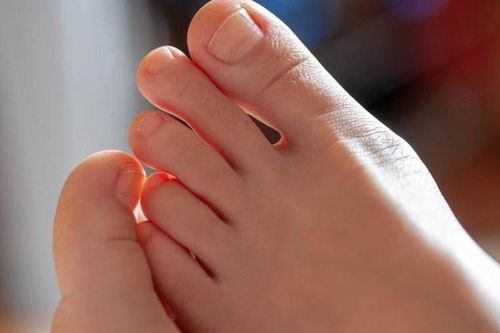 Thủ phạm khiến người phụ nữ phải cắt ngón chân