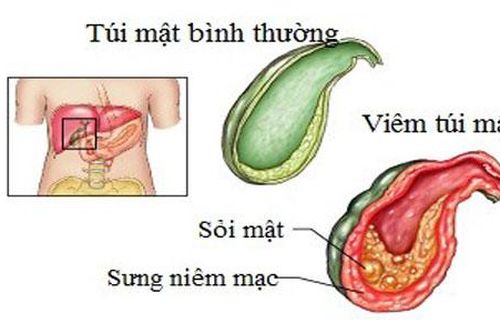 Viêm túi mật và những nguy biến