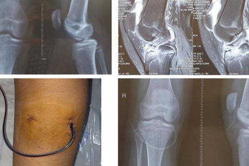 Phẫu thuật bong diện bám dây chằng chéo trước ở trẻ em: Giảm thiểu các hạn chế đáng tiếc
