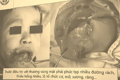 Liên tiếp các trường hợp trẻ nhỏ bị chó cắn, tổn thương nghiêm trọng