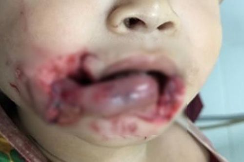 Bé trai bị chó ngoạm vào đầu trong lúc ăn xúc xích