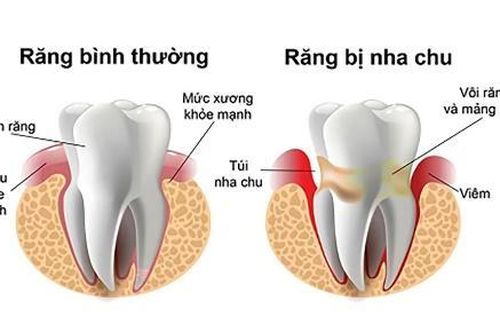Bệnh viêm nha chu ở người mắc bệnh đái tháo đường