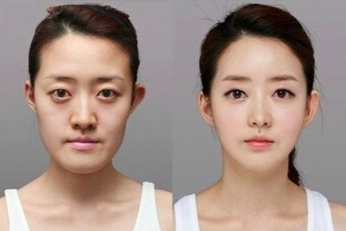 Tại sao người Hàn Quốc bất chấp rủi ro để phẫu thuật thẩm mỹ?