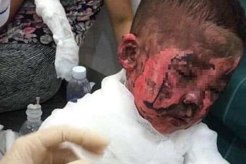 Đốt giấy chơi cháy luôn phòng ngủ, 2 anh em 3 tuổi bỏng toàn thân
