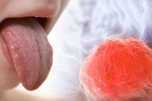 Sau nụ hôn vướng víu, chàng trai dọa chia tay vì nghĩ rằng bạn gái lén đi bấm khuyên lưỡi nhưng nguyên nhân thực sự lại đau lòng hơn nhiều