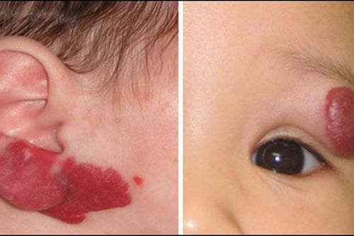 U máu: đừng vội nghĩ đến xạ trị