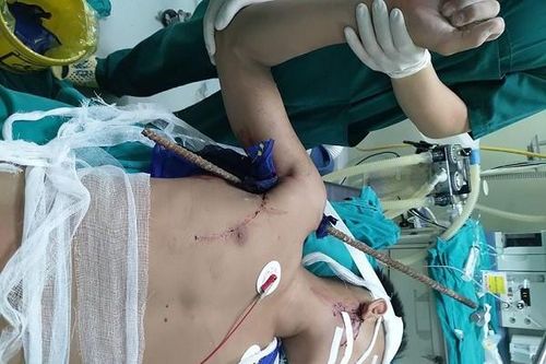 Cứu kịp thời nam thanh niên bị thanh sắt đâm xuyên từ nách lên vai, nguy cơ liệt
