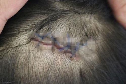 Bé gái bị cuốn vào bánh xe máy vì mặc áo chống nắng