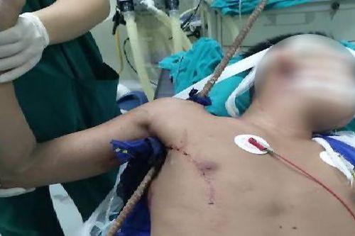 Né gạch rơi, nam thanh niên bị thanh sắt đâm xuyên thấu từ nách lên vai