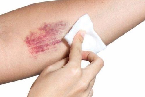 5 cách đánh bay vết bầm tím trên cơ thể một cách nhanh chóng