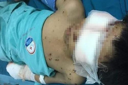 Xót xa cháu bé bị đa chấn thương do vật liệu nổ
