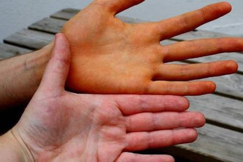 6 dấu hiệu cảnh báo gan của bạn đang có vấn đề