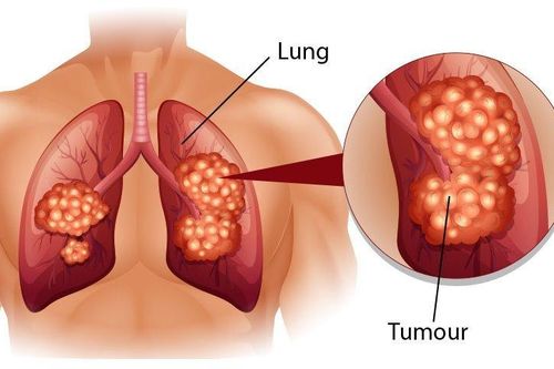 5 loại ung thư nguy hiểm có tính di truyền, nhà có người mắc thì con cái cần đi khám sàng lọc sớm
