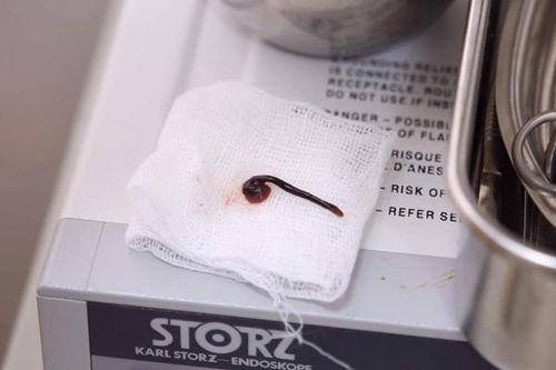 Con vắt 5 cm ngoe nguẩy trong mũi bé trai 3 tuổi