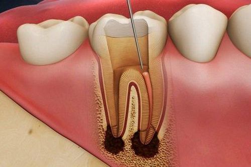Diệt tủy có giữ được răng?