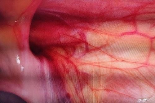 Cảnh giác với thoát vị bẹn ở trẻ em