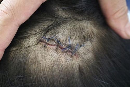 Bé gái bị cuốn vào bánh xe: Hiểm họa từ vật bất ly thân mùa nắng