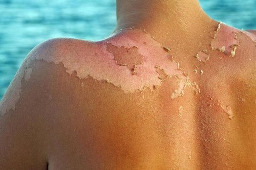 Phòng tác hại của ánh nắng mặt trời sao cho đúng?