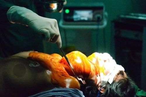 Khi nào cần mổ bướu cổ lành tính?
