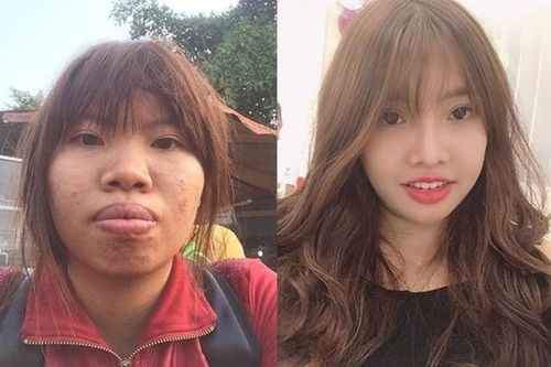 Cô gái dao kéo toàn bộ gương mặt, có chồng mới sau khi ly hôn
