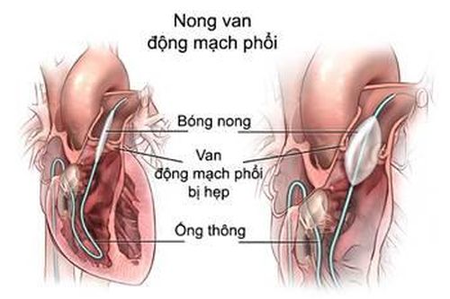 Bệnh hẹp động mạch phổi