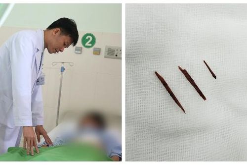 Điều trị thành công bị dăm gỗ đâm thủng thành bụng