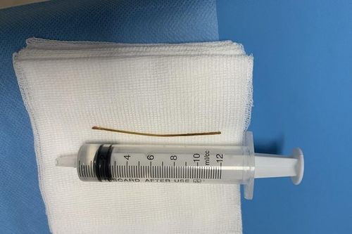 Thích ngậm tăm khi ngủ, người đàn ông bị tăm đâm xuyên ruột