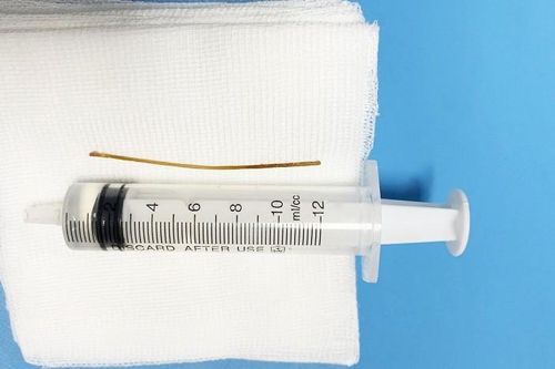 Bác sĩ sử dụng kỹ thuật chưa từng có trong 'sách vở' để lấy tăm trong ruột cho người đàn ông 49 tuổi