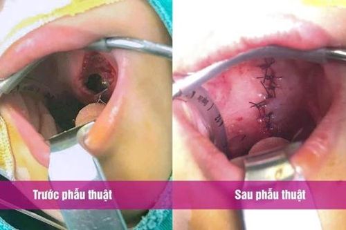 Bé trai 2 tuổi bị đũa chọc rách vòm miệng