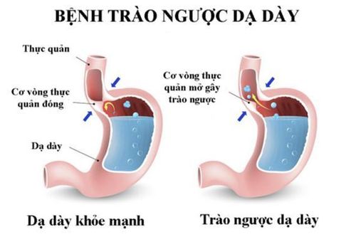 Thuốc trị trào ngược dạ dày - thực quản: Đặc biệt thận trọng khi dùng