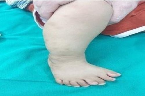 Bàn chân bé trai có tới 9 ngón