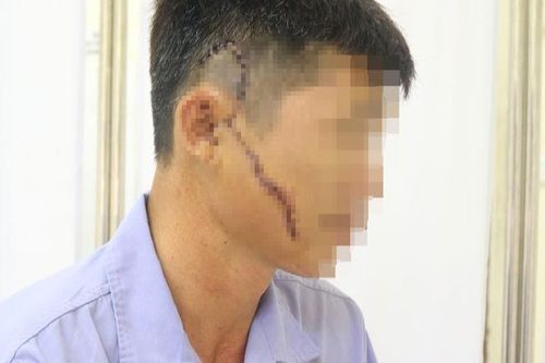 Người đàn ông bị khung tôn sắt nặng 50 kg rơi trúng mặt