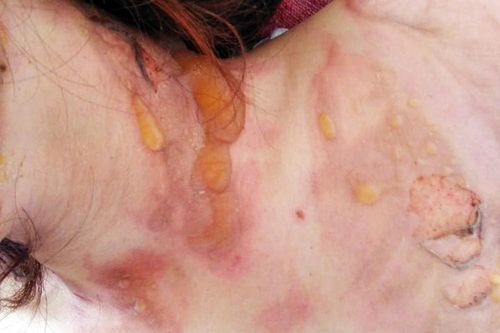 Tự gây thương tích rồi dựng chuyện bị đốt, cướp 500 triệu đồng