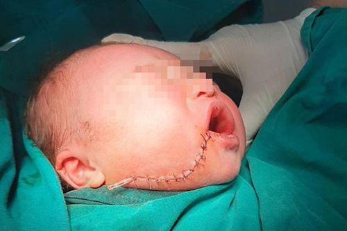 Mẹ đẻ tại nhà, bé sơ sinh bị dao rơi rách mặt