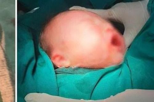 Sinh thường tại gia, bé sơ sinh bị dao rơi rách mặt