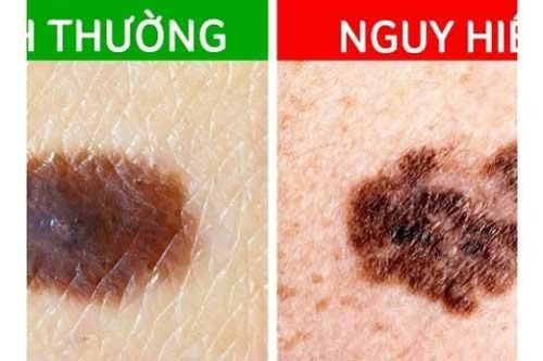 6 dấu hiệu nhận biết sớm nốt ruồi ác tính, nếu thấy mình có 1 biểu hiện cũng phải đi khám ngay
