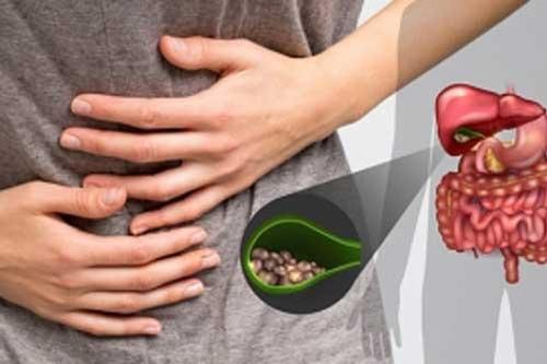 'Chỉ mặt' 3 kiểu ăn uống dễ hình thành sỏi mật: Người Việt mắc cả 3, nên biết sớm để thay đổi