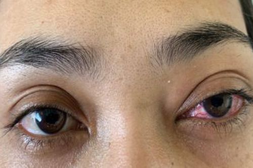 Hai tháng đau mắt đỏ, nữ bệnh nhân không ngờ mắc bệnh hiếm gặp