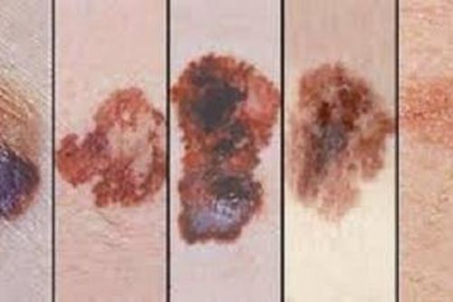 Phát triển miếng dán điều trị ung thư da