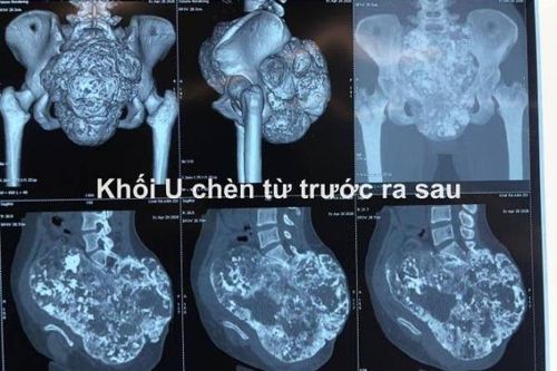 11 giờ phẫu thuật, truyền 22 lít máu, cứu sống cô gái mang khối u khổng lồ