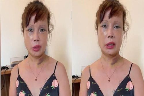 Chưa dừng phẫu thuật thẩm mỹ, cô dâu 62 tuổi 'đại tu' vòng một
