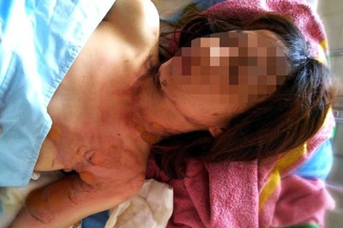Xử lý người tự phóng hỏa đốt thân thể, hoang báo bị cướp 500 triệu