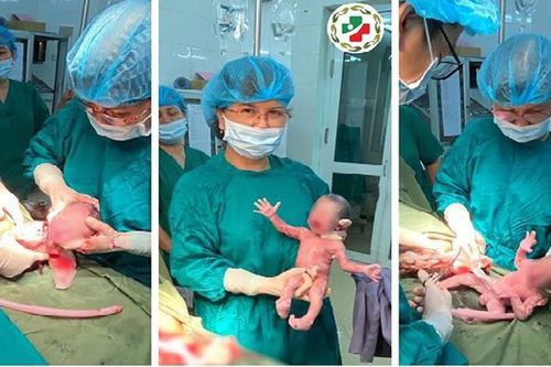 Thai phụ sinh 3 cùng trứng hiếm gặp