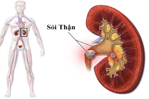 Nhịn tiểu sẽ dẫn đến nguy cơ hình thành cặn sỏi, rối loạn tiểu tiện