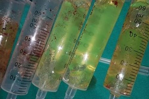 Vỡ túi nâng ngực sau khi phẫu thuật thẩm mỹ