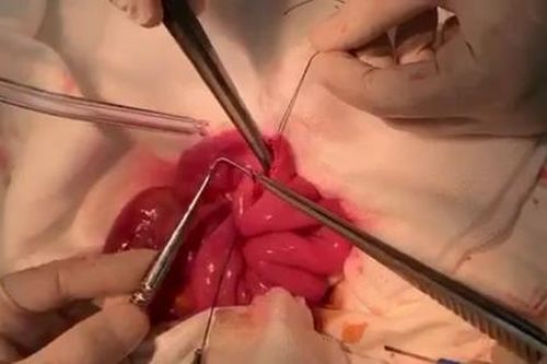 Lấy lưỡi câu nằm trong ruột non một phụ nữ